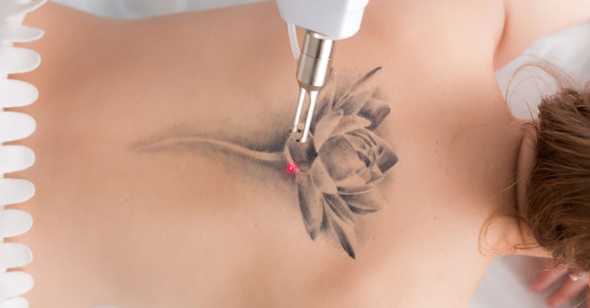 Committedly Follow the Laser Tattoo Removal Post-Care Guidelines 