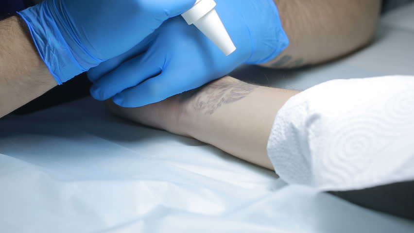 Committedly Follow the Laser Tattoo Removal Post-Care ...